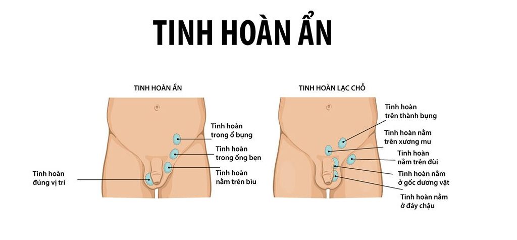 ẩn tinh hoàn