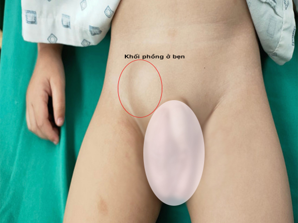 thoát vị bẹn