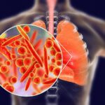 Viêm phổi do vi khuẩn Mycoplasma - Hành trang sức khoẻ